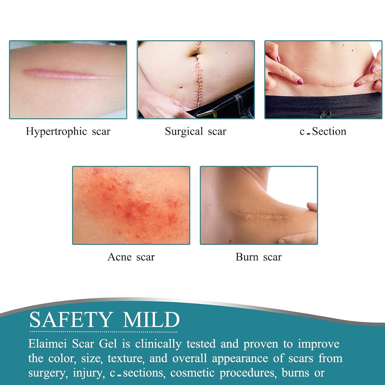DermaFade™ Silicone Scar Sheets